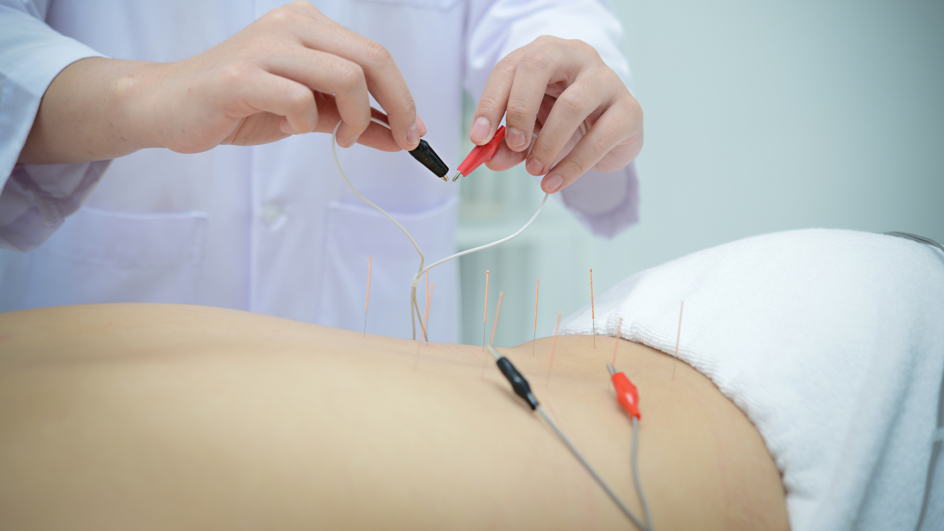 Acupuncture