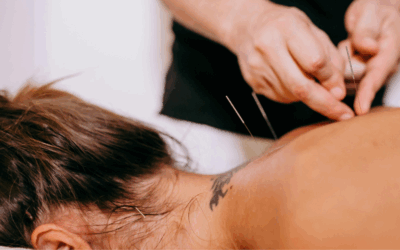 Dry Needling at On Point Natural Medicine and Acupuncture Newcastle