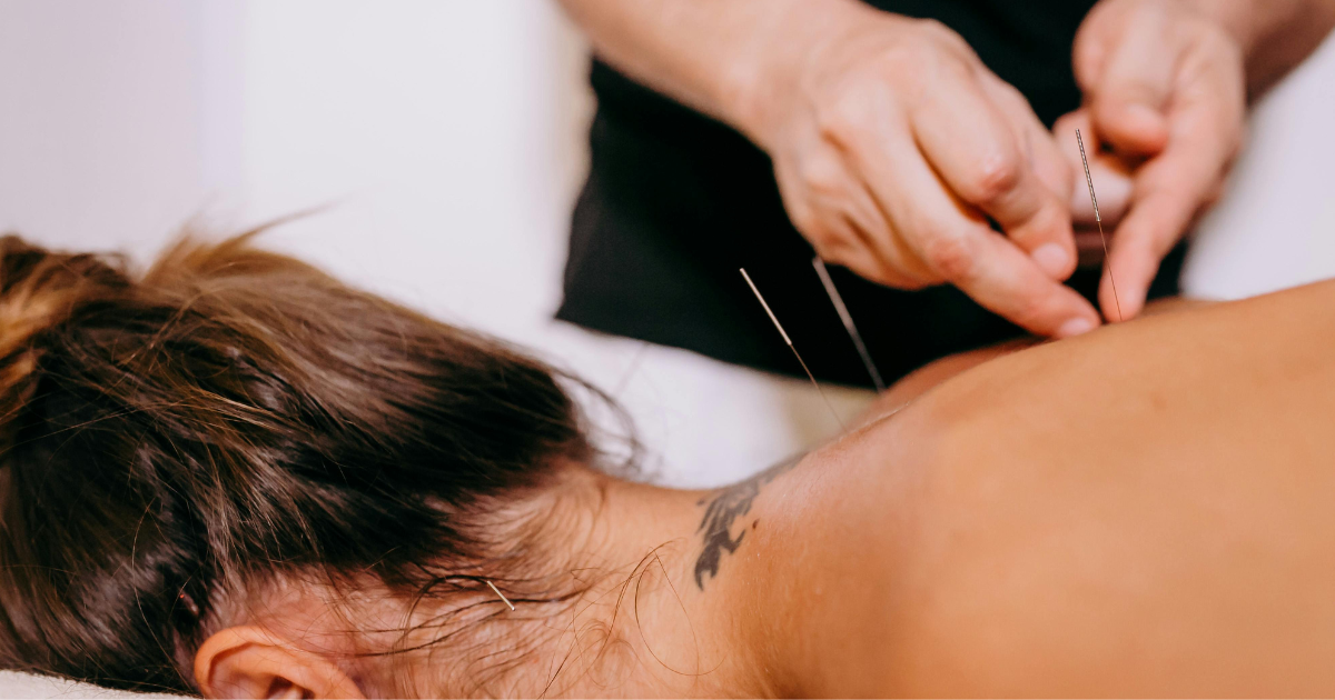 Acupuncture needles being gently inserted into a patient’s upper back by a trained practitioner