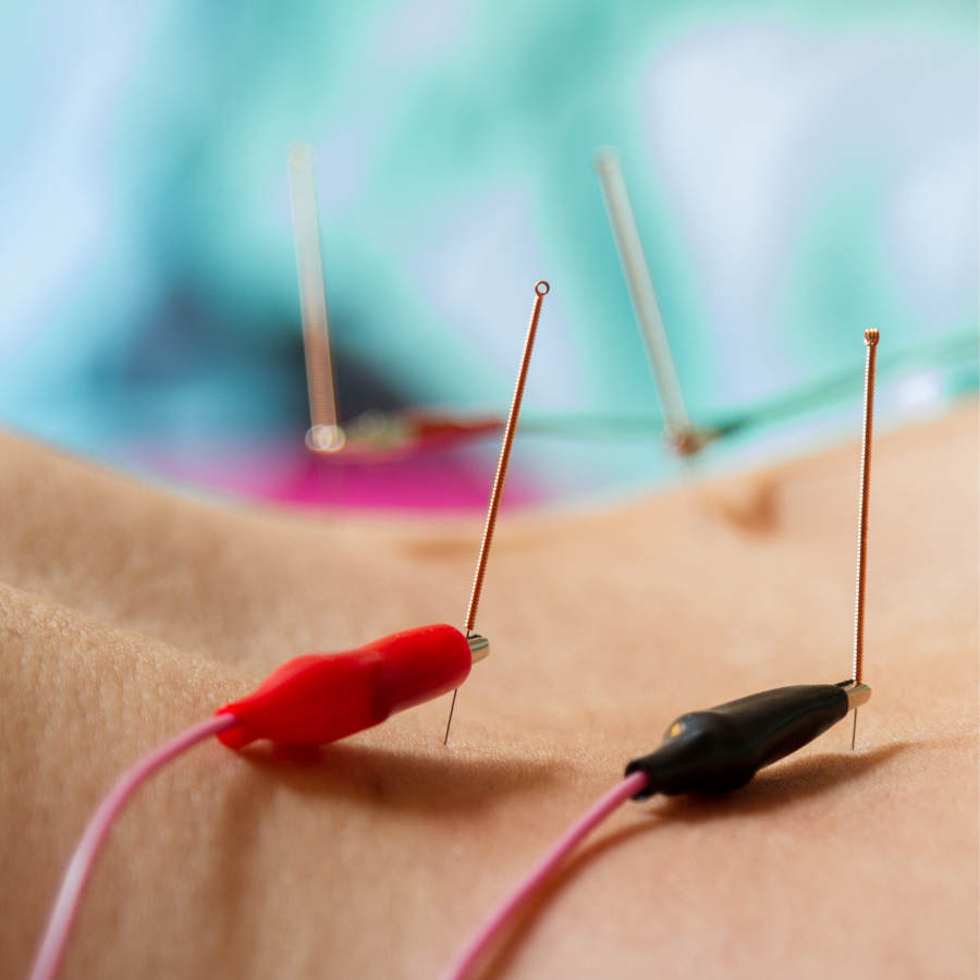 A close-up photo of an acupuncture practitioner's hand holding a needle next to a patient's hand.
